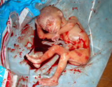 killed human fetus.jpg